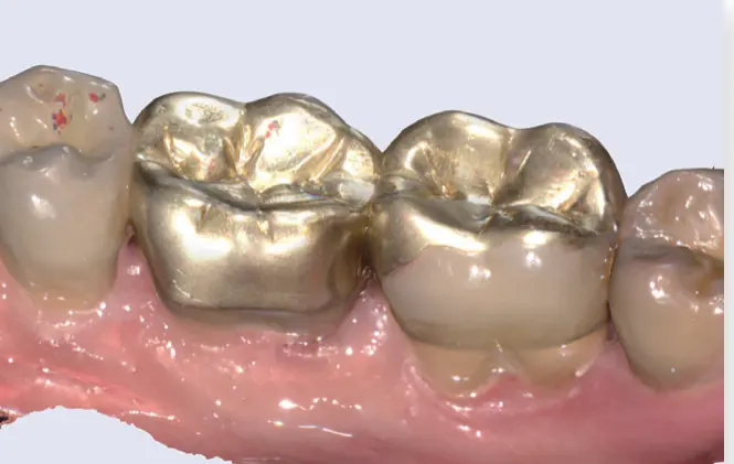 Scanare a unor coroane metalice existente, fără pudrare
