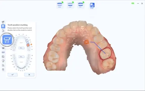 Trasarea automată a liniei de finiție pe o preparație, cu diagrama de selecție a dintelui