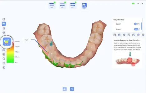Detecția zonelor retentive: zonele de concavitate marcate cu verde pe arcada mandibulară, cu scală în micrometri